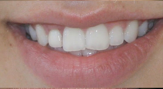 Acevedo Dental Group Dental Implant before/after treatment