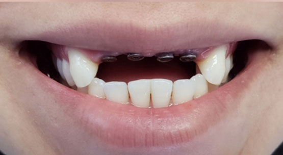 Acevedo Dental Group Dental Implant before/after treatment