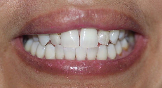 Acevedo Dental Group teeth whitening before and after