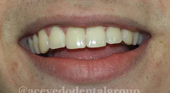 Acevedo Dental Group teeth whitening before and after