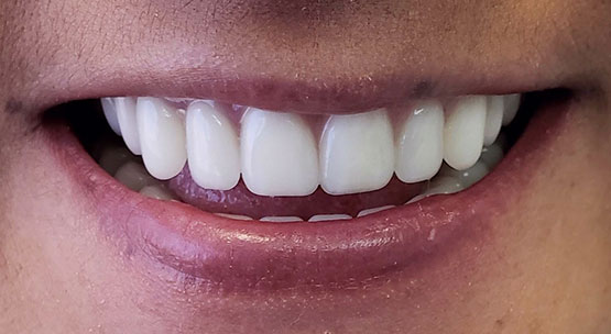 implants over dentures - after treatment