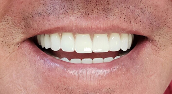 implantes sobre dentaduras postizas - después del tratamiento