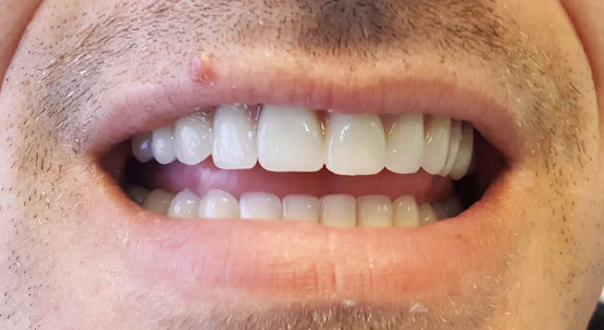 implantes sobre dentaduras postizas - después del tratamiento