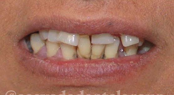 implants over dentures - before treatment