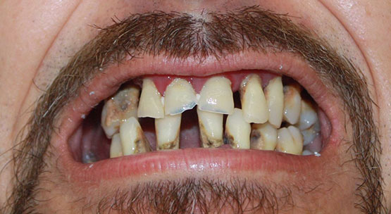 implantes sobre dentaduras postizas - antes del tratamiento
