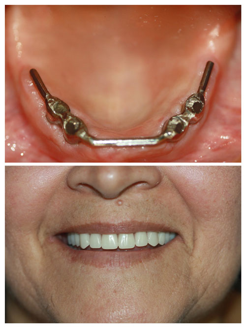 dental implants supported dentures - acevedo dental group