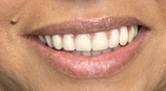 sonrisa-implante-dental-después