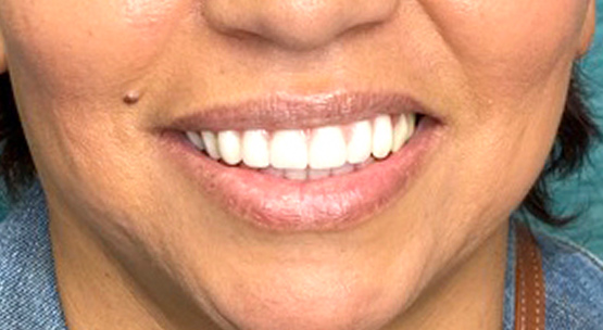 implantes dentales - smile - after