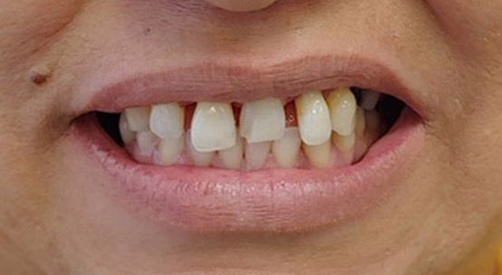 sonrisa-implante-dental-antes