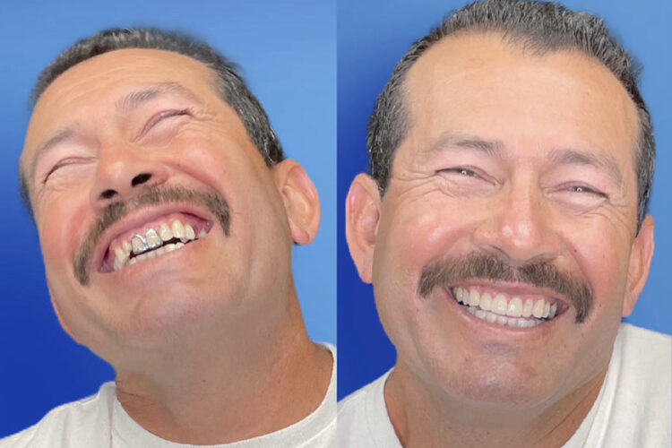 implant supported dentures