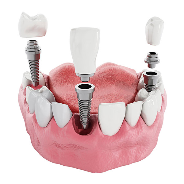 dental implants multiple teeth representation module