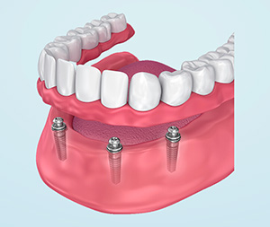 dental implant supported denture dental implant denture