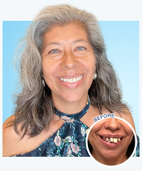 dental implant smile after full arch dental implant denture restoration patient smile