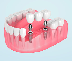 multiple dental implant - implant bridge illustration module