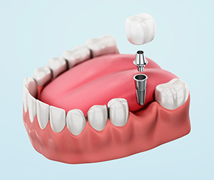 single dental implant illustration module