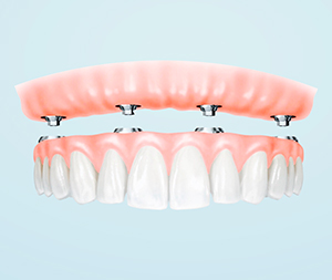 all on 4 dental implants full arch restoration