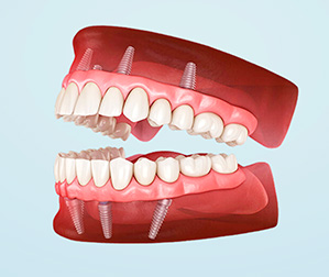full arch dental implant all on 4 hybrid teeth illustration