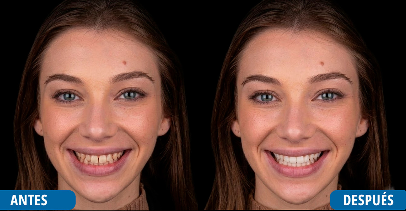 Resultado de la sonrisa con Invisalign, antes y después de la transformación con ortodoncia discreta Invisalign con Acevedo Dental en Montebello, Ontario, y Santa Ana, California.